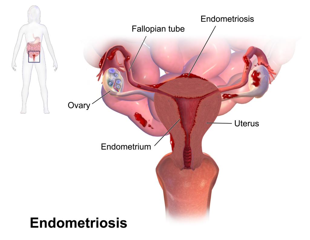 endometriosis surgeon