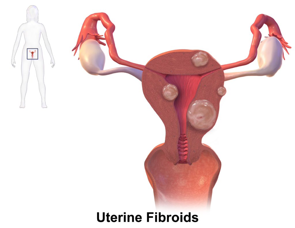 fibroid surgeon
